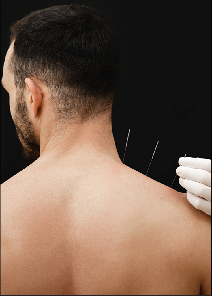 acupuncture vancouver